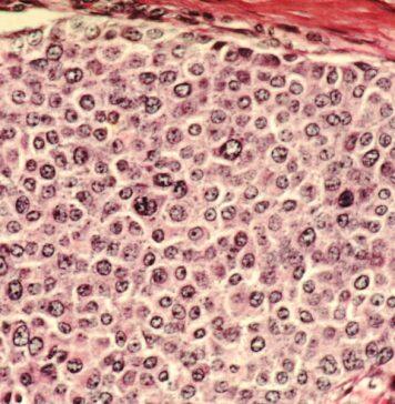 A Sugar Hit to Help Destroy Cancer Cells