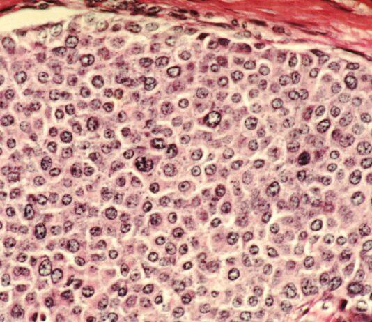 A Sugar Hit to Help Destroy Cancer Cells