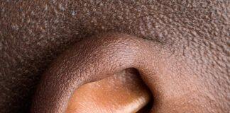 Hearing deterioration reported by discharged COVID-19 patients