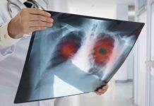 ECLS trial shows reduction in late-stage diagnoses of lung cancer