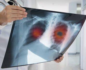 ECLS trial shows reduction in late-stage diagnoses of lung cancer