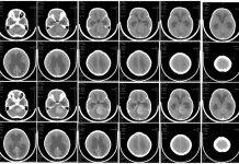 In test with mice, Zika virus eliminates brain tumor common in children