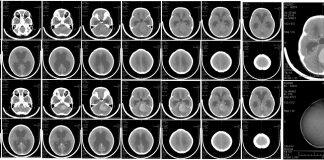 In test with mice, Zika virus eliminates brain tumor common in children