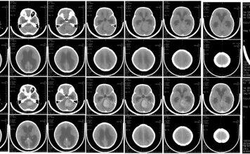 In test with mice, Zika virus eliminates brain tumor common in children