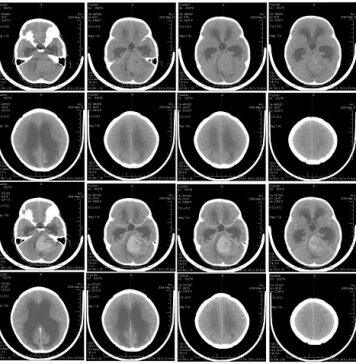 In test with mice, Zika virus eliminates brain tumor common in children