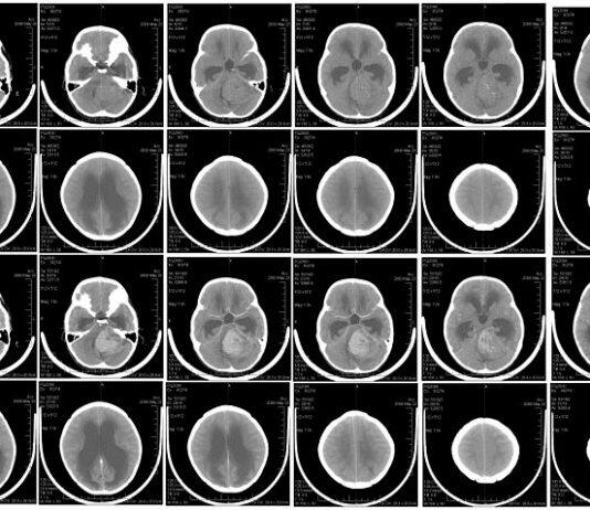 In test with mice, Zika virus eliminates brain tumor common in children
