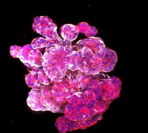 Monash discoveries suggest new breast cancer treatment
