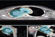 University of Glasgow Set to Play Leading Role in ‘First of Its King’ Clinical Trail to Bring Hope to People With Lung Cancer