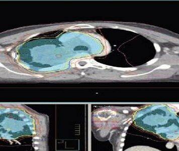 University of Glasgow Set to Play Leading Role in ‘First of Its King’ Clinical Trail to Bring Hope to People With Lung Cancer