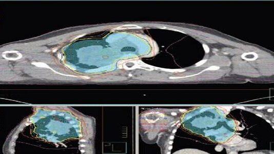 University of Glasgow Set to Play Leading Role in ‘First of Its King’ Clinical Trail to Bring Hope to People With Lung Cancer