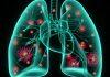 Why COVID-19 pneumonia lasts longer, causes more damage than typical pneumonia