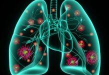 Why COVID-19 pneumonia lasts longer, causes more damage than typical pneumonia