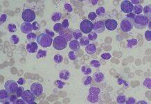 Hull York Medical School Identifies Genetic Tendency in Leukaemia Cells