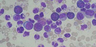 Hull York Medical School Identifies Genetic Tendency in Leukaemia Cells