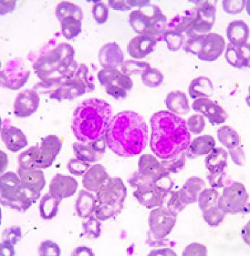 Targeted elimination of leukemic stem cells