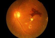 Discovery of a new drug for diabetic retinopathy