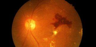 Discovery of a new drug for diabetic retinopathy