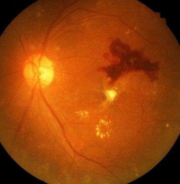 Discovery of a new drug for diabetic retinopathy