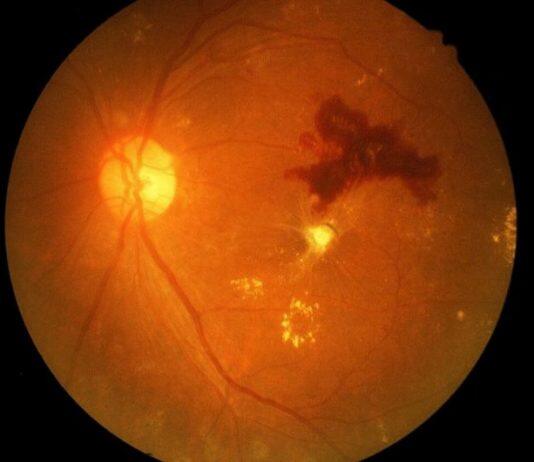 Discovery of a new drug for diabetic retinopathy