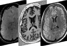 Powerful brain imaging provides new insights on neurological symptoms of COVID-19