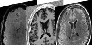 Powerful brain imaging provides new insights on neurological symptoms of COVID-19