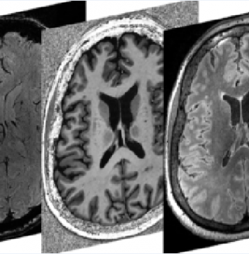 Powerful brain imaging provides new insights on neurological symptoms of COVID-19