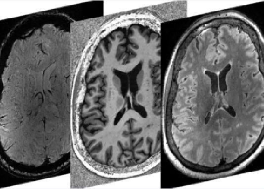 Powerful brain imaging provides new insights on neurological symptoms of COVID-19