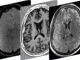 Powerful brain imaging provides new insights on neurological symptoms of COVID-19