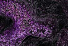 Jump in cancer diagnoses at 65 implies patients wait for Medicare, according to Stanford study