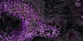 Jump in cancer diagnoses at 65 implies patients wait for Medicare, according to Stanford study