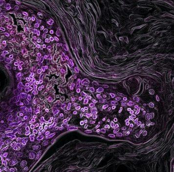 Jump in cancer diagnoses at 65 implies patients wait for Medicare, according to Stanford study