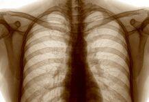 New national study of long-term impacts of lung damage from COVID-19