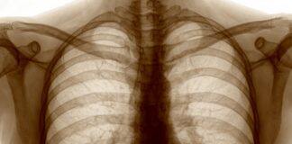 New national study of long-term impacts of lung damage from COVID-19