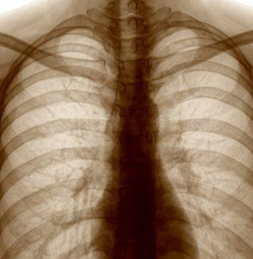 New national study of long-term impacts of lung damage from COVID-19