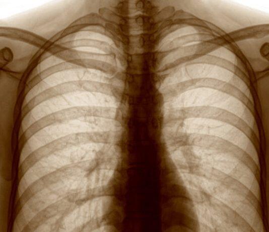 New national study of long-term impacts of lung damage from COVID-19