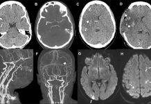 Covid-19 vaccine: Common stroke symptoms must be ‘urgently evaluated’