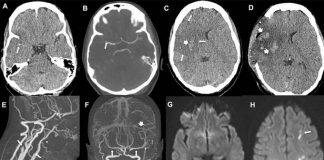 Covid-19 vaccine: Common stroke symptoms must be ‘urgently evaluated’