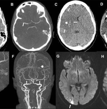 Covid-19 vaccine: Common stroke symptoms must be ‘urgently evaluated’