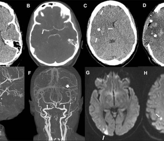 Covid-19 vaccine: Common stroke symptoms must be ‘urgently evaluated’