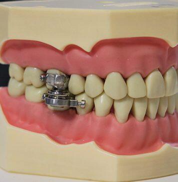 Researchers develop world-first weight loss device
