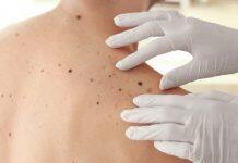 World-first 3D imaging for melanoma detection