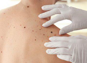 World-first 3D imaging for melanoma detection