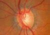 Vitamin B3 trialled as glaucoma treatment