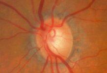 Vitamin B3 trialled as glaucoma treatment