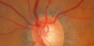 Vitamin B3 trialled as glaucoma treatment