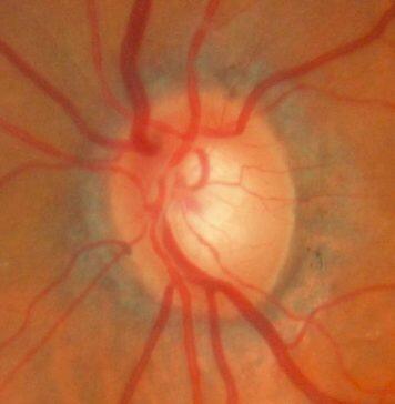 Vitamin B3 trialled as glaucoma treatment