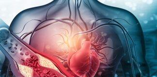 Game-changing new therapy to lower cholesterol and stabilise plaques associated with heart attack