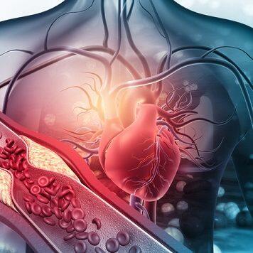 Game-changing new therapy to lower cholesterol and stabilise plaques associated with heart attack