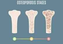 Simple clinical tool can help diagnose spinal fractures in people with osteoporosis