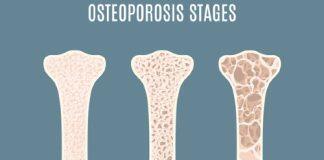 Simple clinical tool can help diagnose spinal fractures in people with osteoporosis